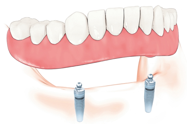 001-rozwiazania-zwiazane-z-implantami-stomatologicznymi