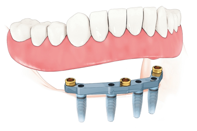 002-rozwiazania-zwiazane-z-implantami-stomatologicznymi